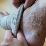 Coping With Varicose Veins