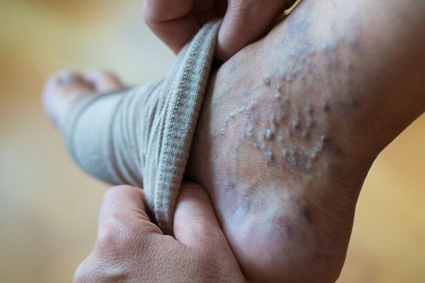 Coping With Varicose Veins