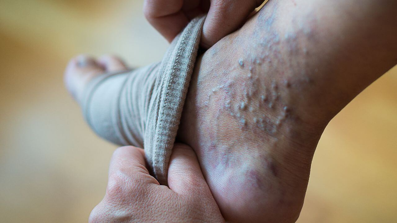 Coping With Varicose Veins